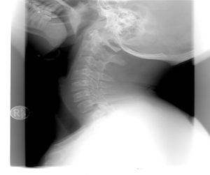 X-Ray of a Neck
